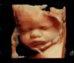 Photo of a black-and-white 3D ultrasound scan