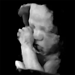 Black and white 3D ultrasound image of a baby