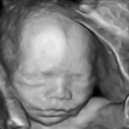 Black and white 3D ultrasound image of a baby