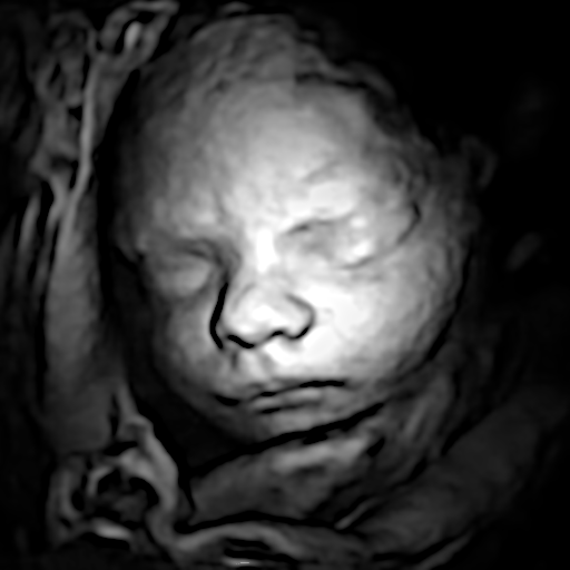 Black and white 3D ultrasound image of a baby