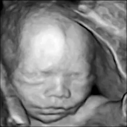 Black and white 3D ultrasound image of a baby