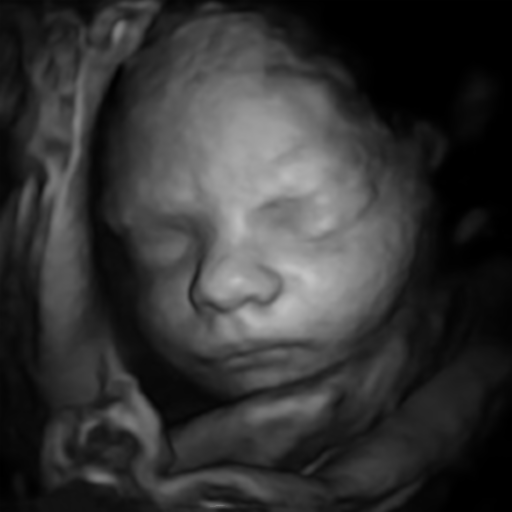 Black and white 3D ultrasound image of a baby