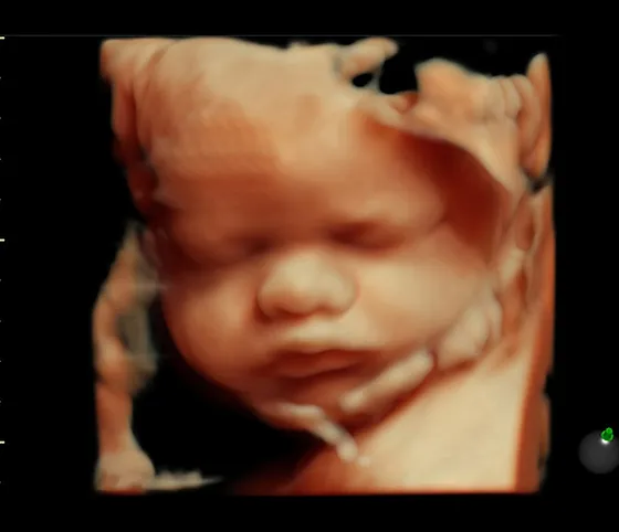 Black and white 3D ultrasound image of a baby