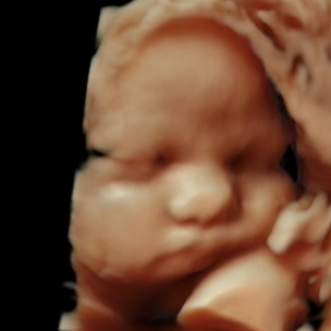 Black and white 3D ultrasound image of a baby