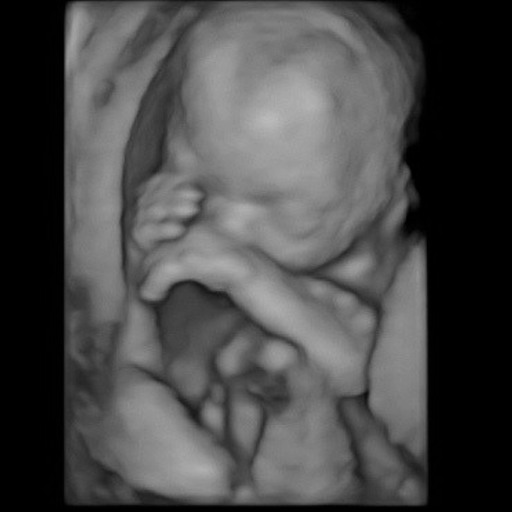 Black and white 3D ultrasound image of a baby