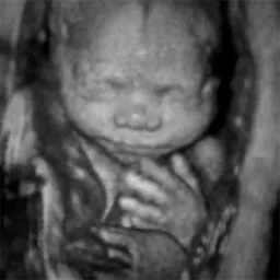 Black and white 3D ultrasound image of a baby