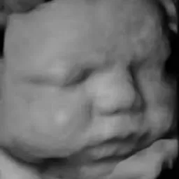 Black and white 3D ultrasound image of a baby