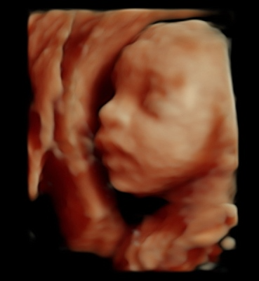 Black and white 3D ultrasound image of a baby